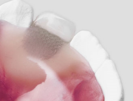 4pc Orthodontie dentaire intra-orale Acier inoxydable Miroirs de