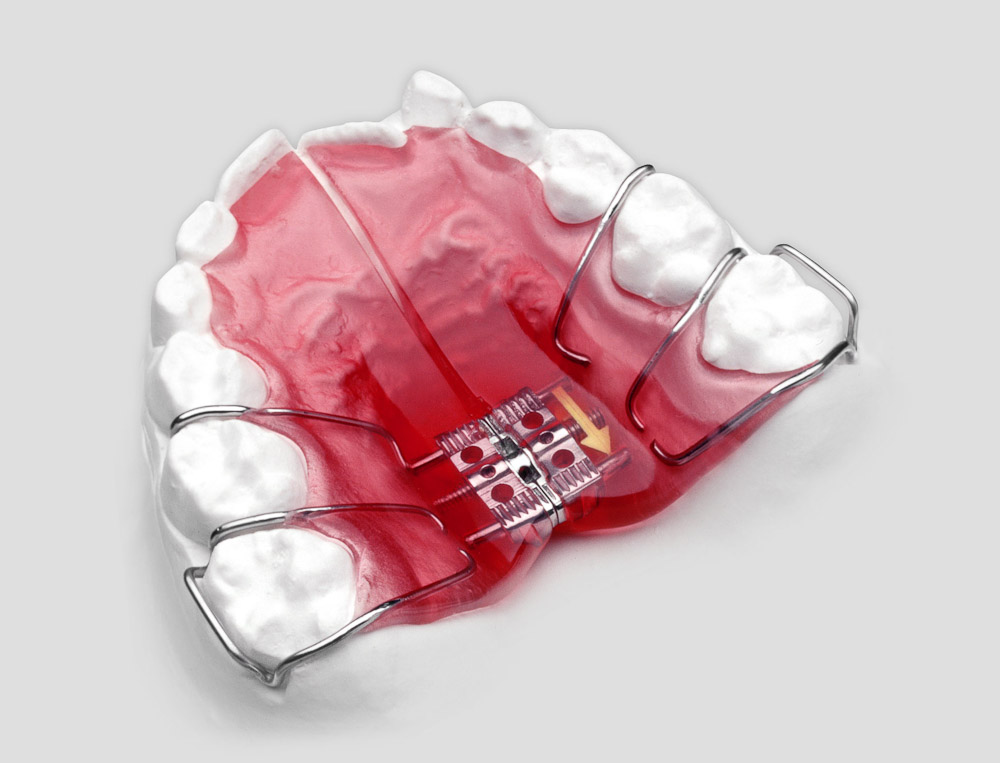 The upper Schwarz is a slow expansion appliance without any occlusal pads